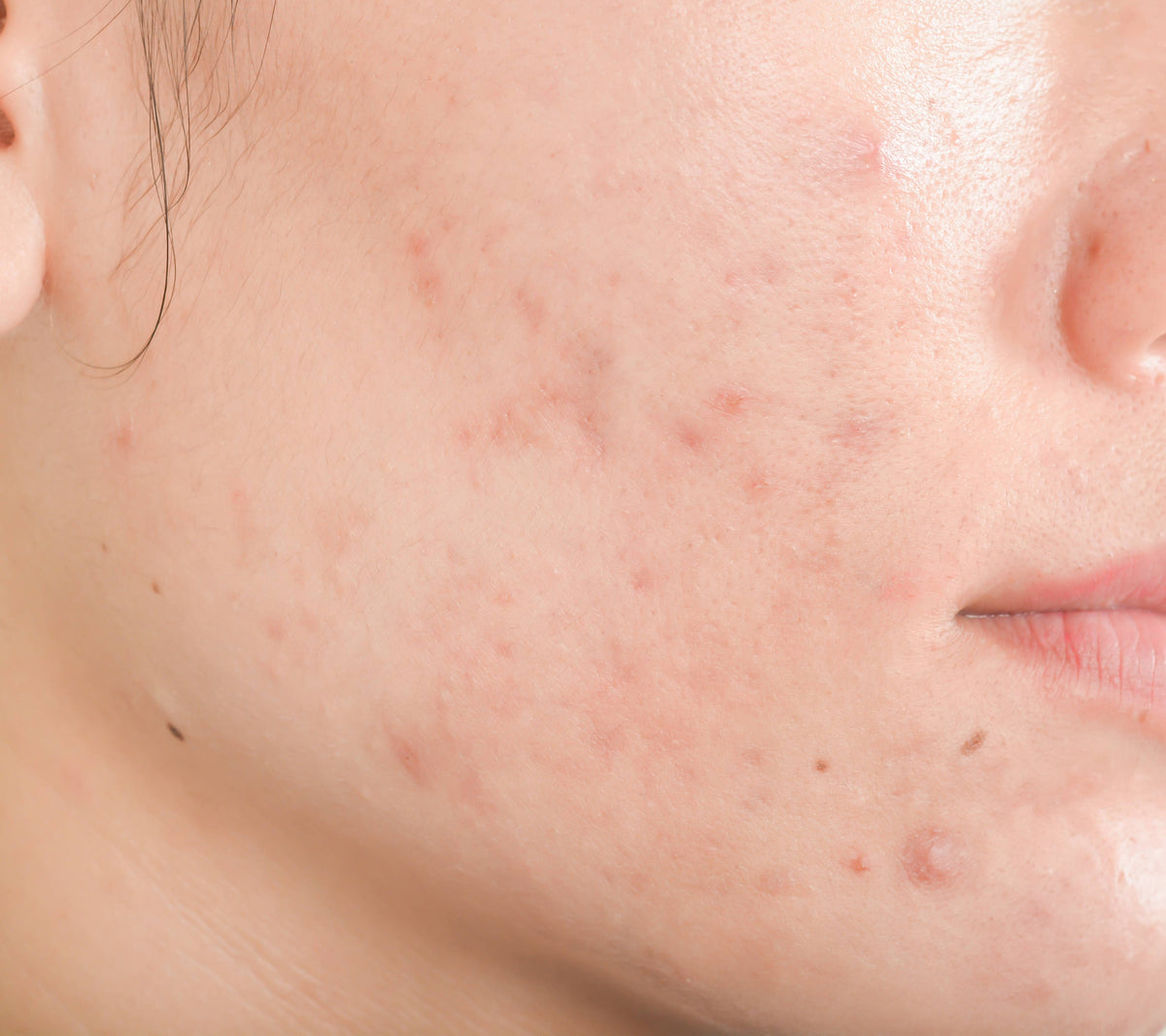 Bye Bye Blemish Spot Treatment